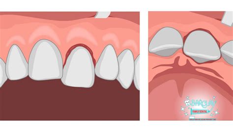 Tooth Luxation: Types, Causes, Symptoms, and Treatment