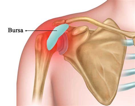 Osteopathic Treatment Of Shoulder Bursitis | Better Health Osteopathy