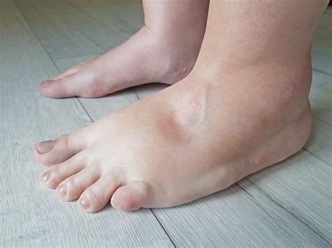 What Is Edema and How Is It Treated?: Jacksonville Vein Specialists ...