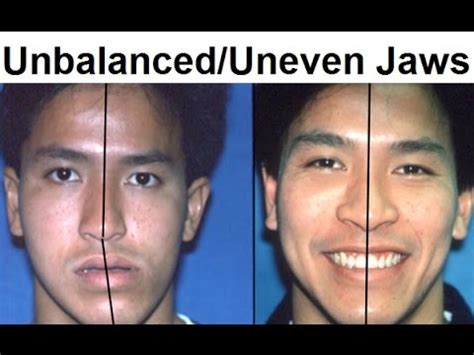 18 Images Best Do Braces Fix Jawline