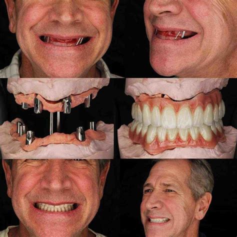 What is the cost of full mouth dental implants - Dental News Network