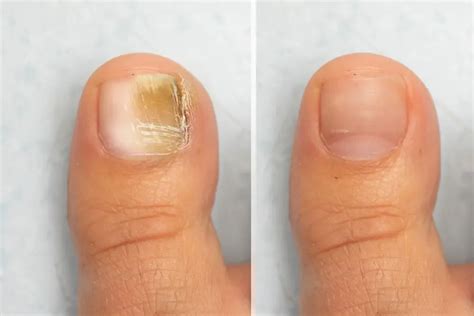 Here are 3 Incredible Toenail Fungus Pictures Before and After Taking ...