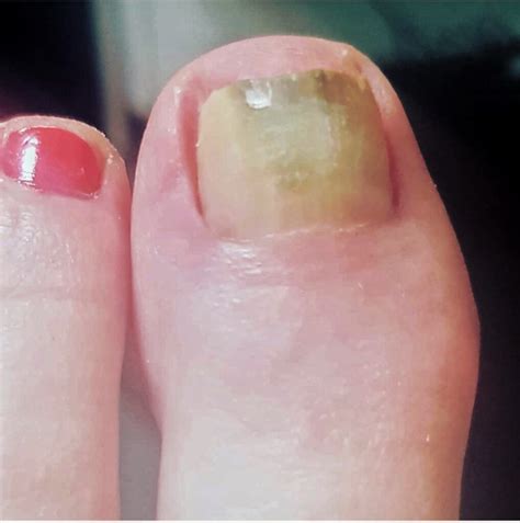 Green Nail Syndrome | The Chelsea Clinic