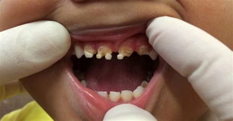 You Will Be Shocked by What Caused This Child’s Massive Tooth Decay ...