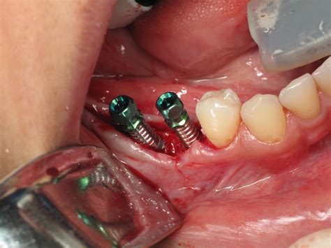 Computer Guided Dental Implant Surgery - Guides Online