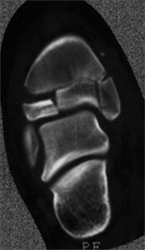 Fracture Education : Evaluation