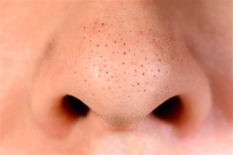 Removing blackheads: the best and worst approaches