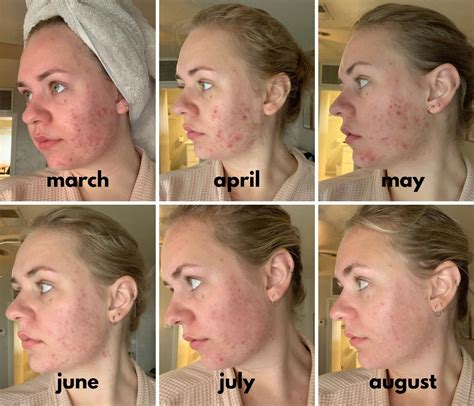 [B&A] Hormonal Acne 6 Month Progress - Spironolactone / Aczone / Retin ...