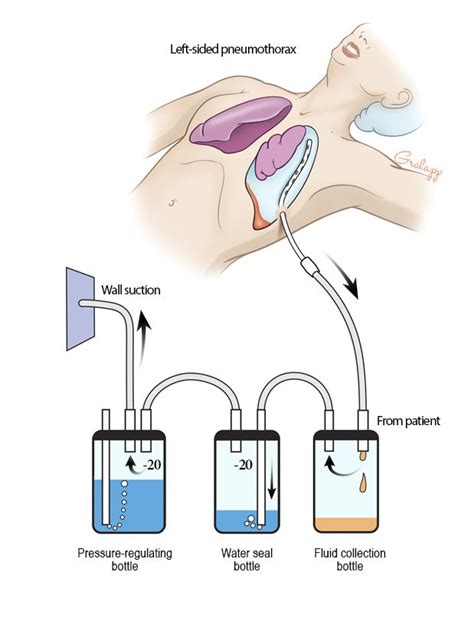 chest tube - Google Search | Nursing school survival, Medical school ...