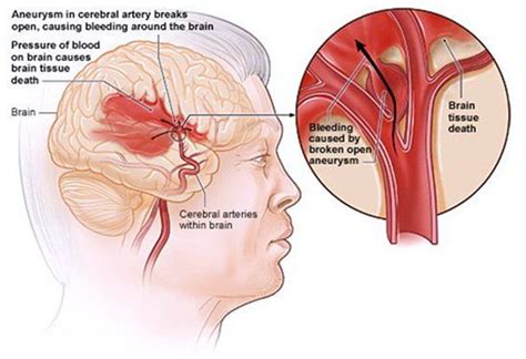 Brain Hemorrhage | Varicose veins | Vascular surgeon | Stroke | DVT ...