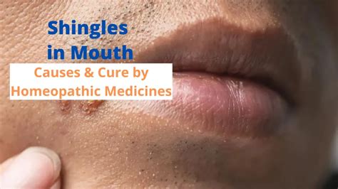 Shingles in Mouth– Symptoms, Causes & Homeopathic Medicines