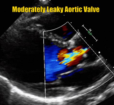 Aortic Regurgitation – A Leaky Aortic Valve • MyHeart