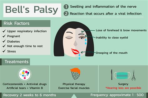 Bell's Palsy | Eye Patient