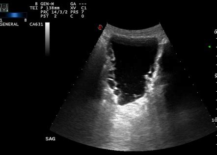 Multiple bladder diverticula | Image | Radiopaedia.org