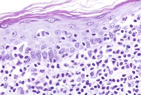 Cutaneous T-Cell Lymphoma Incidence on the Rise in the United States ...