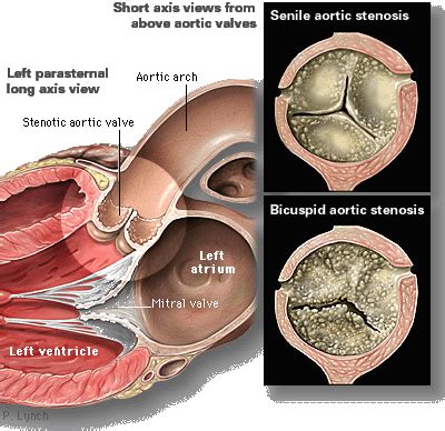 Aortic Stenosis Topic Review | Learn the Heart