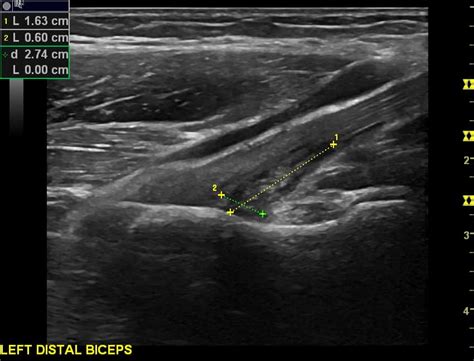 Distal Biceps Rupture Ultrasound