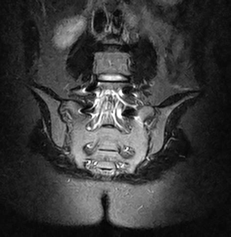 Sacroiliac joints MRI scan | Medserena Open MRI