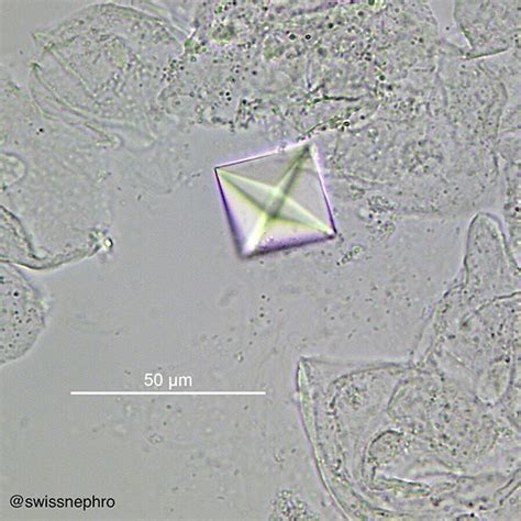 Huge calcium oxalate dihydrate (weddellite) crystal. (Bright field ...