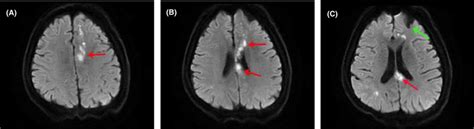 MRI images showing acute cerebral infarction in multiple sites of the ...