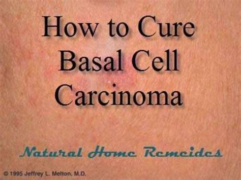 Cure basal cell carcinaoma with natural home remedies