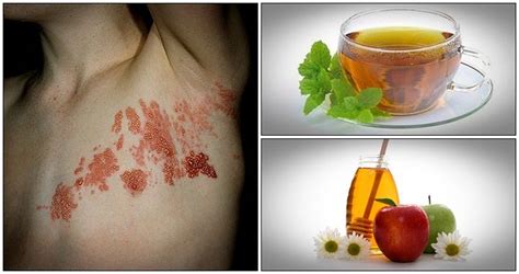 24 Home Remedies For Shingles For Healthy Skin - Healthreviewcenter