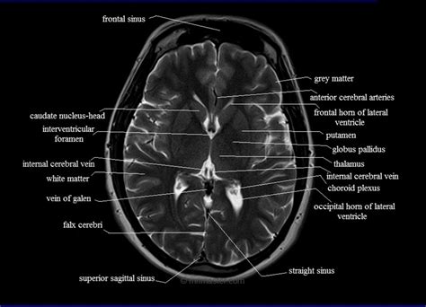 Mri Brain Anatomy