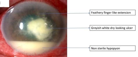 MYCOTIC (FUNGAL) CORNEAL ULCER - New