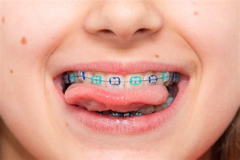 Ultimate Guide to Braces for Kids - Best Dental Care for Kids