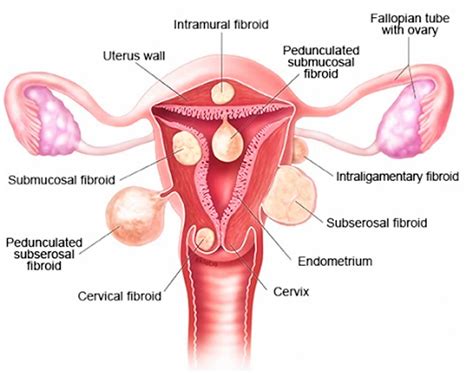 Myomectomy procedure risks, recovery time & pregnancy after myomectomy