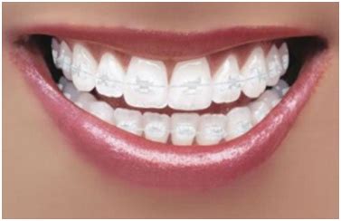 Six Month Smiles & Cosmetic Braces System provided by London Dentist