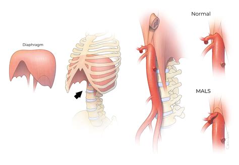 Median Arcuate Ligament Syndrome (MALS) | McGovern Medical School