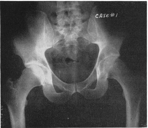 Entrapment Neuropathy of the Ilioinguinal Nerve | NEJM