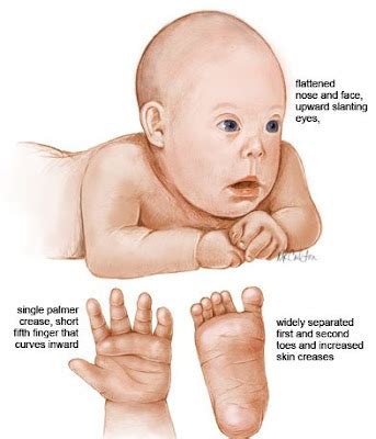 Health Teller: Down Syndrome (Trisomy 21)