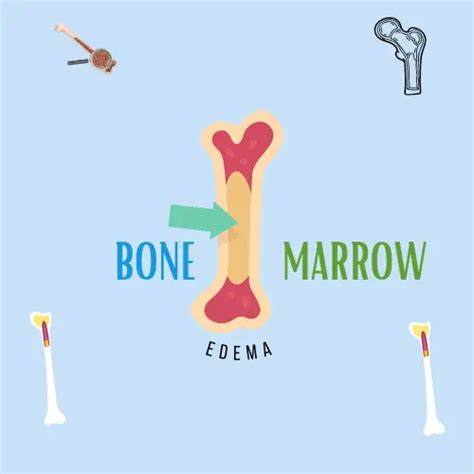 Understanding Bone Marrow Edema: Causes, Symptoms, and Treatment ...