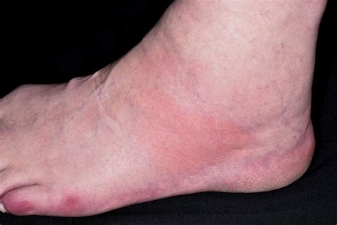 Swollen Ankle In Gout Photograph by Dr P. Marazzi/science Photo Library