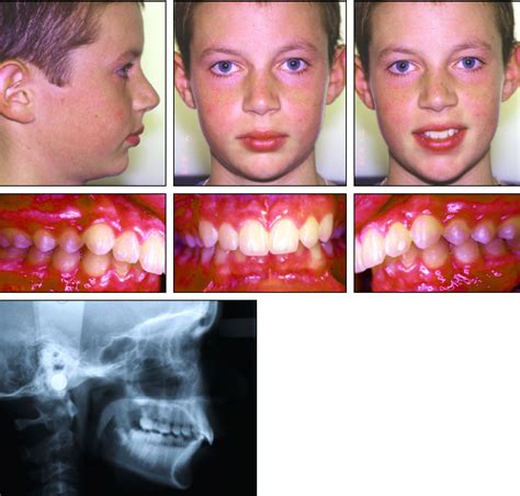 Twin Force Bite Corrector for Class II Molar Distalization