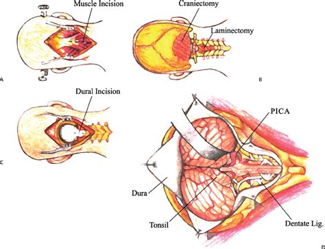 Basic Concepts in Posterior Fossa Surgery | Neupsy Key