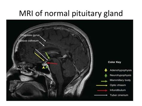 Normal Pituitary Mri Scan