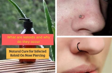 10 Natural Home Remedies For Curing Infected Keloid On Nose Piercing