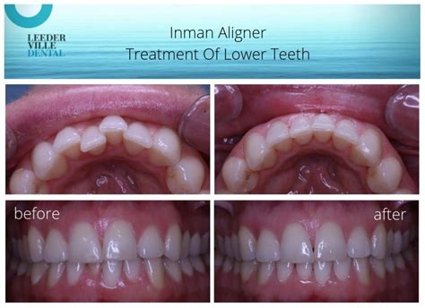 Before and after Inman Aligner used to straighten lower teeth at ...