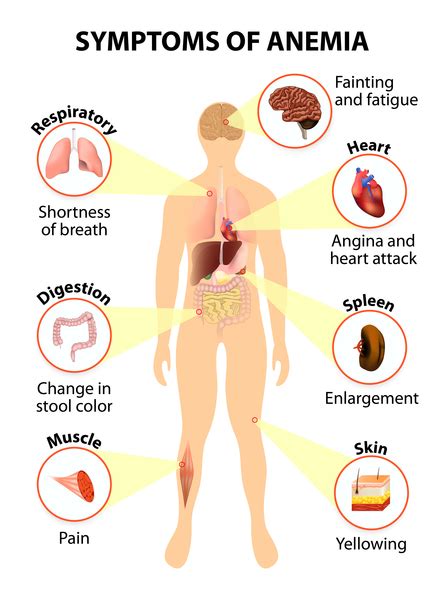 Iron Deficiency Anemia