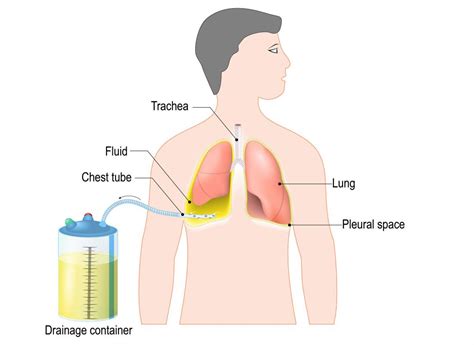 Chest tube insertion: Uses, procedure, and recovery