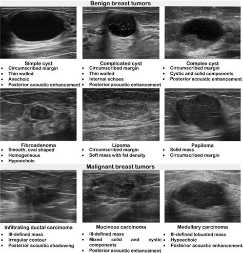 Description of the sonographic appearance exhibited by different breast ...