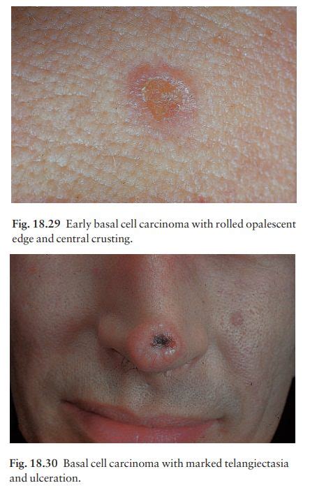 Basal cell carcinoma (rodent ulcer)