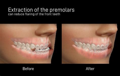 Orthodontic Extraction vs. Non-extraction: Which is Best for Me?