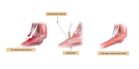 Distal Biceps Tendonitis