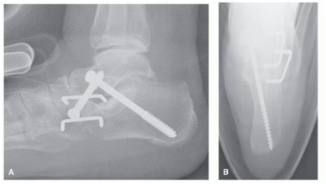 Triple Arthrodesis | Musculoskeletal Key