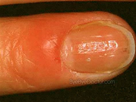 Paronychia – Symptoms, Causes, Treatment, Prevention, Pictures ...