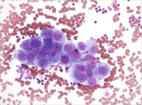 Pleural fluid cytology: differentiated mesothelioma; hemorrhagic ...